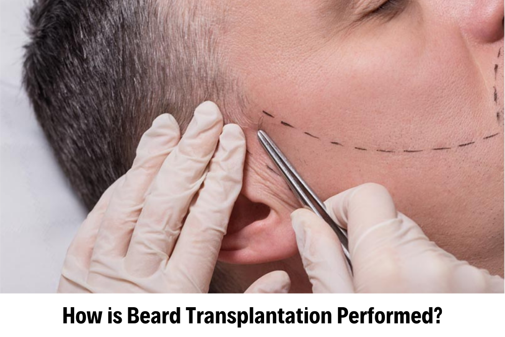 Beard Transplant